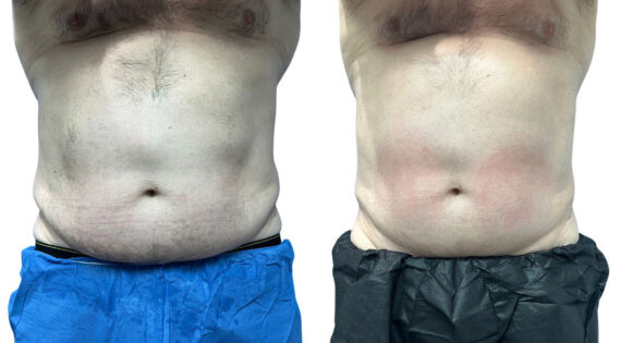 EMSculpt NEO Before and After Photos in Miami Beach, FL, Patient 2286