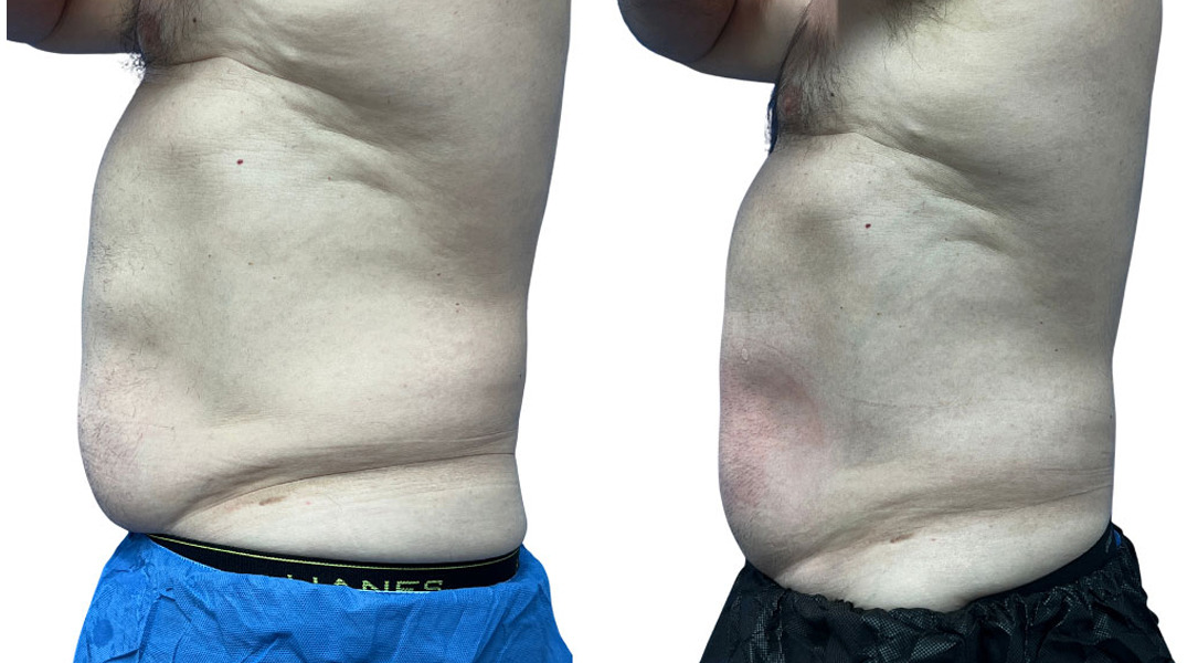 EMSculpt NEO Before and After Photos in Miami Beach, FL, Patient 2286