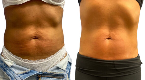 EMSculpt NEO Before and After Photos in Miami Beach, FL, Patient 2288