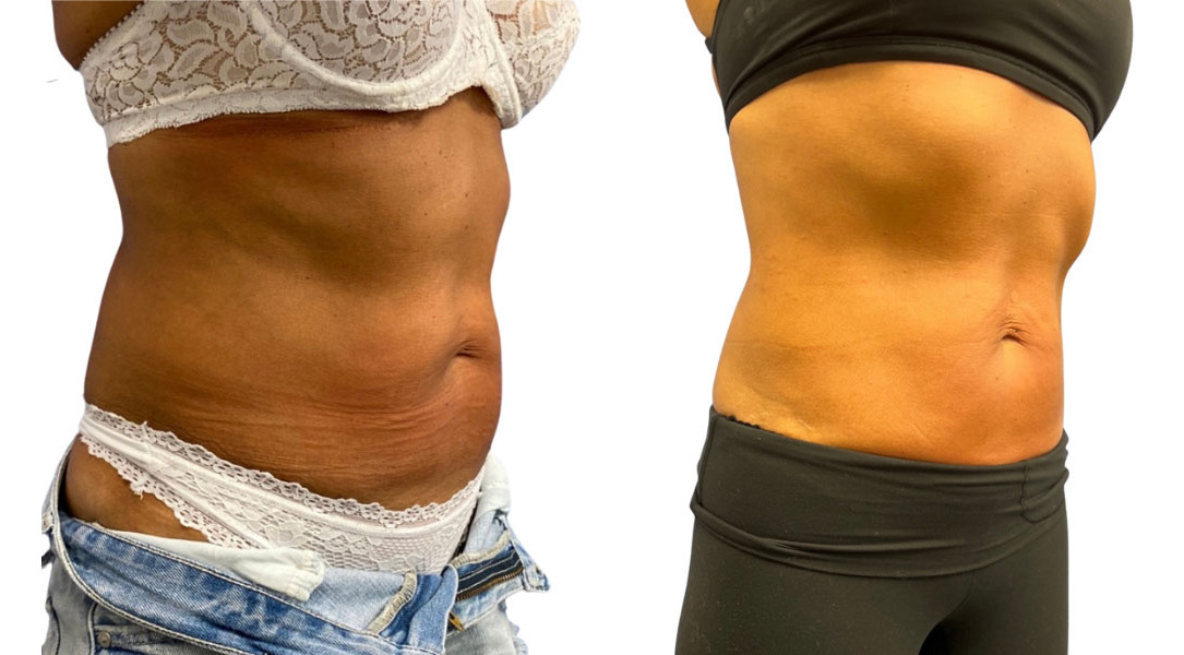EMSculpt NEO Before and After Photos in Miami Beach, FL, Patient 2288