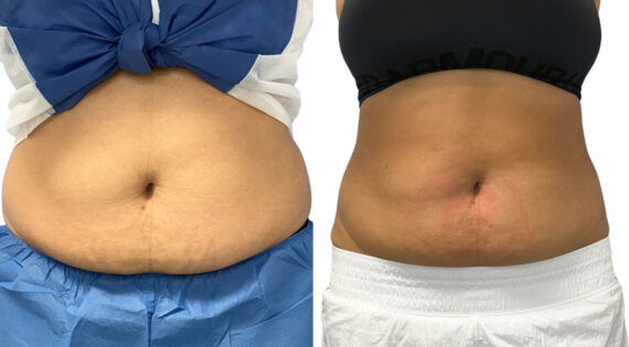 EMSculpt NEO Before and After Photos in Miami Beach, FL, Patient 2290