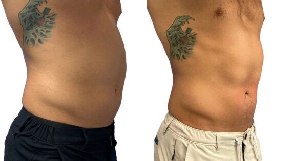 EMSculpt NEO Before and After Photos in Miami Beach, FL, Patient 2292