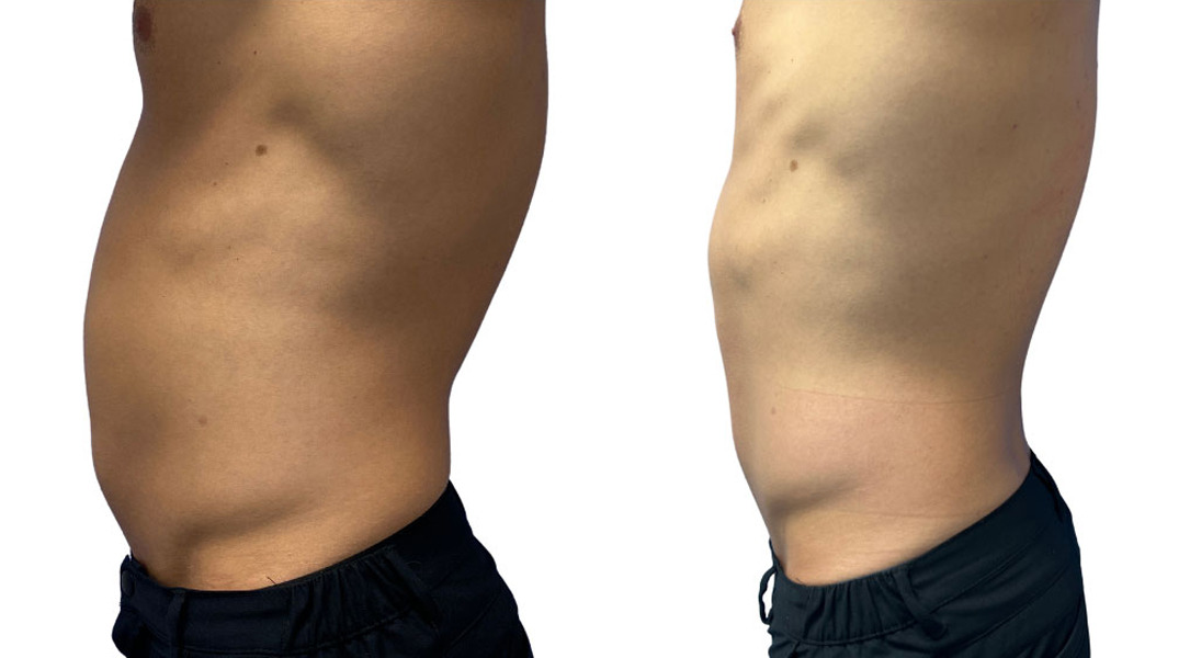 EMSculpt NEO Before and After Photos in Miami Beach, FL, Patient 2292
