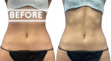 EMSculpt NEO Before and After Photos in Miami Beach, FL, Patient 2294