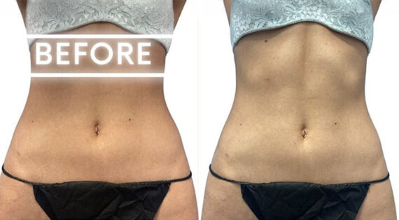 EMSculpt NEO Before and After Photos in Miami Beach, FL, Patient 2294