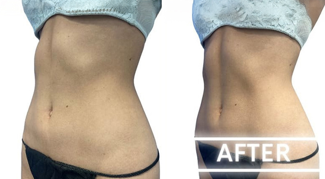 EMSculpt NEO Before and After Photos in Miami Beach, FL, Patient 2294