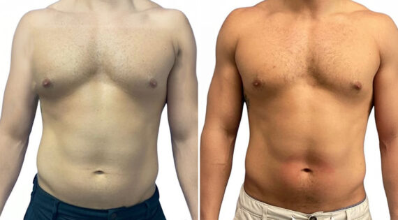 EMSculpt NEO Before and After Photos in Miami Beach, FL, Patient 2296