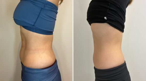 EMSculpt NEO Before and After Photos in Miami Beach, FL, Patient 2298
