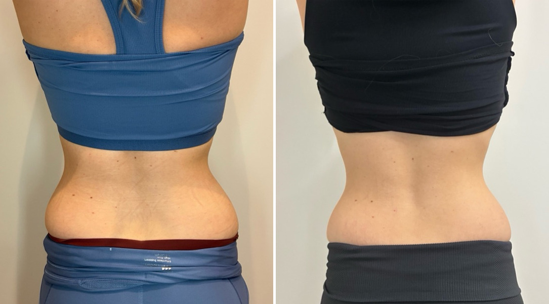 EMSculpt NEO Before and After Photos in Miami Beach, FL, Patient 2298