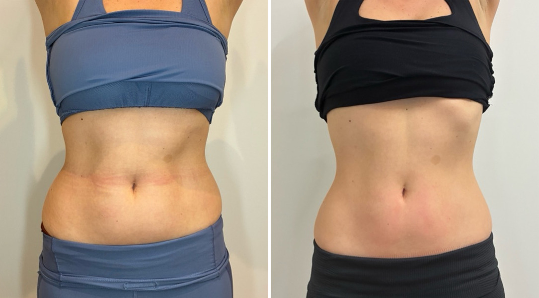 EMSculpt NEO Before and After Photos in Miami Beach, FL, Patient 2298