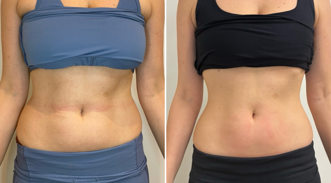 EMSculpt NEO Before and After Photos in Miami Beach, FL, Patient 2298