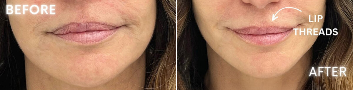 Threading Before and After Photos in Miami Beach, FL, Patient 2430