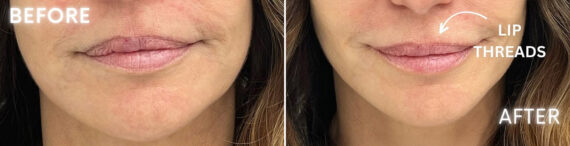 Threading Before and After Photos in Miami Beach, FL, Patient 2430