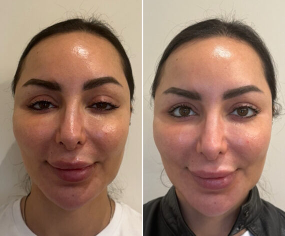 Upneeq Before and After Photos in Miami Beach, FL, Patient 2434