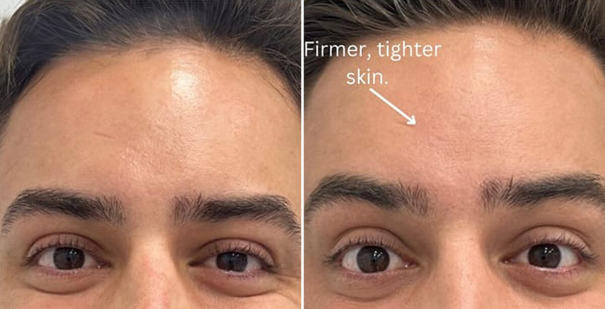 Microneedling Before and After Photos in Miami Beach, FL, Patient 2438