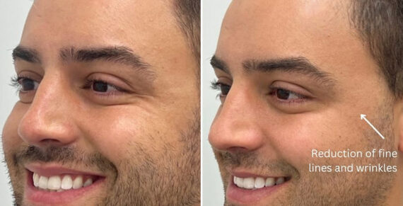 Microneedling Before and After Photos in Miami Beach, FL, Patient 2438