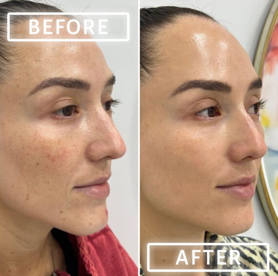 Microneedling Before and After Photos in Miami Beach, FL, Patient 2445