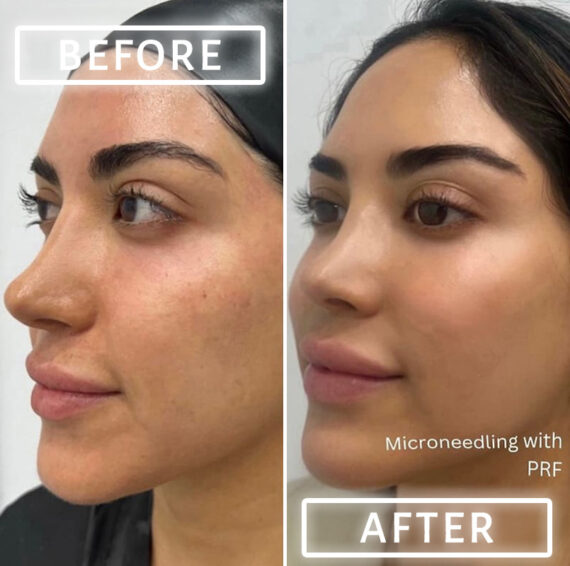 Microneedling Before and After Photos in Miami Beach, FL, Patient 2449