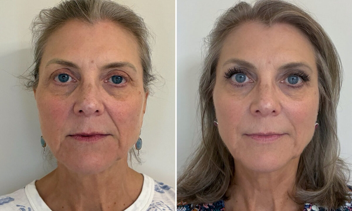 Facial Balancing Before and After Photos in Miami Beach, FL, Patient 2713