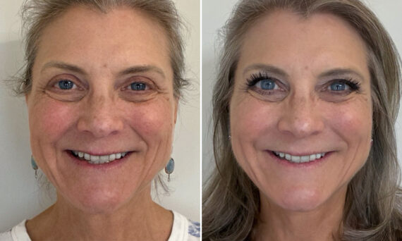 Facial Balancing Before and After Photos in Miami Beach, FL, Patient 2713