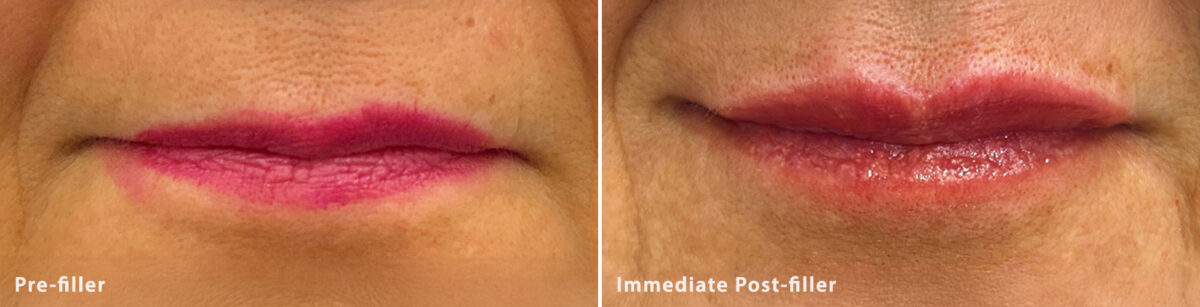 Lip Fillers Before and After Photos in Miami Beach, FL, Patient 2726