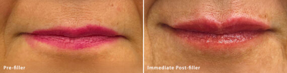 Lip Fillers Before and After Photos in Miami Beach, FL, Patient 2726