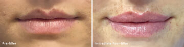 Lip Fillers Before and After Photos in Miami Beach, FL, Patient 2730