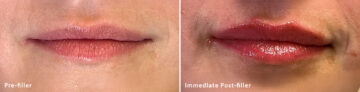 Lip Fillers Before and After Photos in Miami Beach, FL, Patient 2739