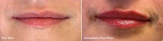 Lip Fillers Before and After Photos in Miami Beach, FL, Patient 2739