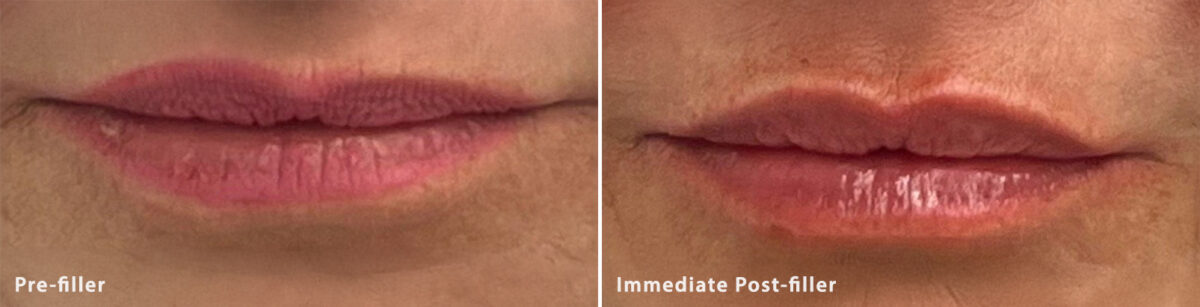 Lip Fillers Before and After Photos in Miami Beach, FL, Patient 2746