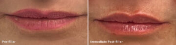 Lip Fillers Before and After Photos in Miami Beach, FL, Patient 2746