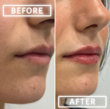 Lip Fillers Before and After Photos in Miami Beach, FL, Patient 2750