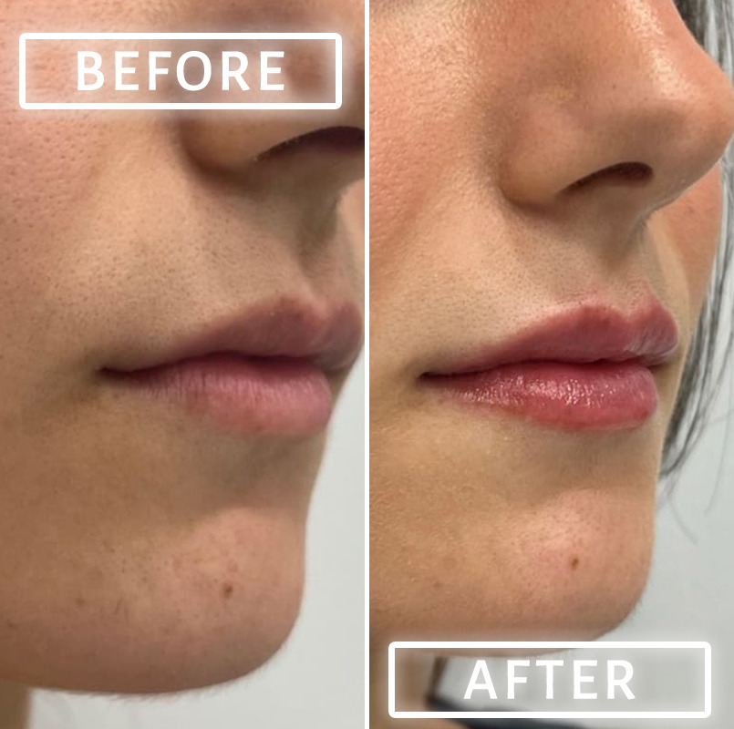 Lip Fillers Before and After Photos in Miami Beach, FL, Patient 2750