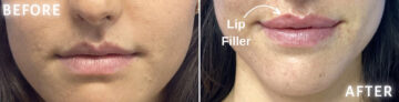 Lip Fillers Before and After Photos in Miami Beach, FL, Patient 2757