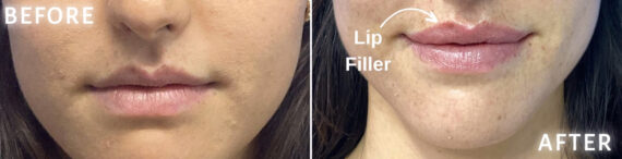 Lip Fillers Before and After Photos in Miami Beach, FL, Patient 2757