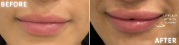 Lip Fillers Before and After Photos in Miami Beach, FL, Patient 2761