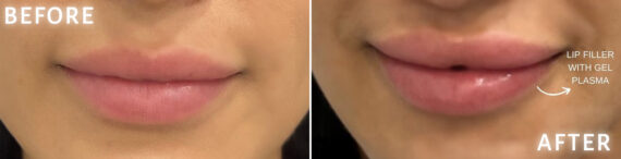 Lip Fillers Before and After Photos in Miami Beach, FL, Patient 2761