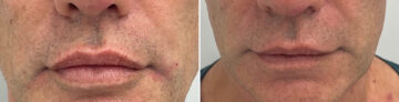 Lip Fillers Before and After Photos in Miami Beach, FL, Patient 2766