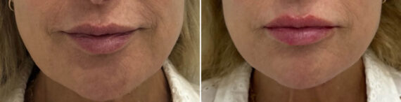 Lip Fillers Before and After Photos in Miami Beach, FL, Patient 2944