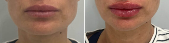 Lip Fillers Before and After Photos in Miami Beach, FL, Patient 2948