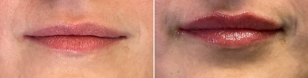 Patient 2952 Lip Fillers Before After