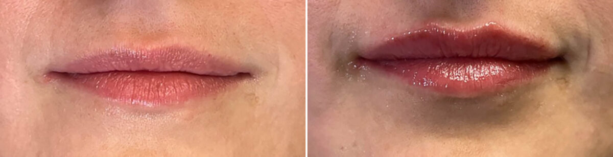 Lip Fillers Before and After Photos in Miami Beach, FL, Patient 2952