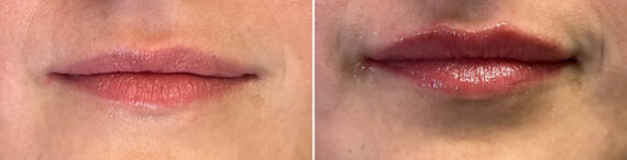 Lip Fillers Before and After Photos in Miami Beach, FL, Patient 2952