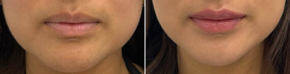 Lip Fillers Before and After Photos in Miami Beach, FL, Patient 2956