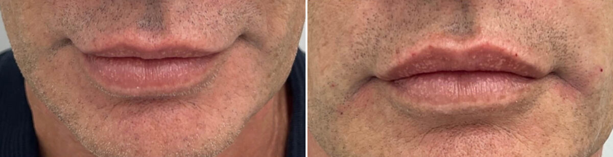 Lip Fillers Before and After Photos in Miami Beach, FL, Patient 2960