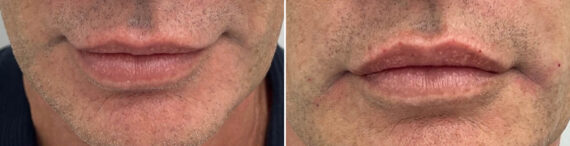 Lip Fillers Before and After Photos in Miami Beach, FL, Patient 2960
