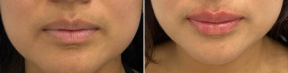 Lip Fillers Before and After Photos in Miami Beach, FL, Patient 2964