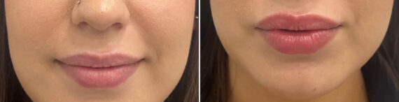 Lip Fillers Before and After Photos in Miami Beach, FL, Patient 2968