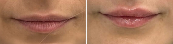 Lip Fillers Before and After Photos in Miami Beach, FL, Patient 2972