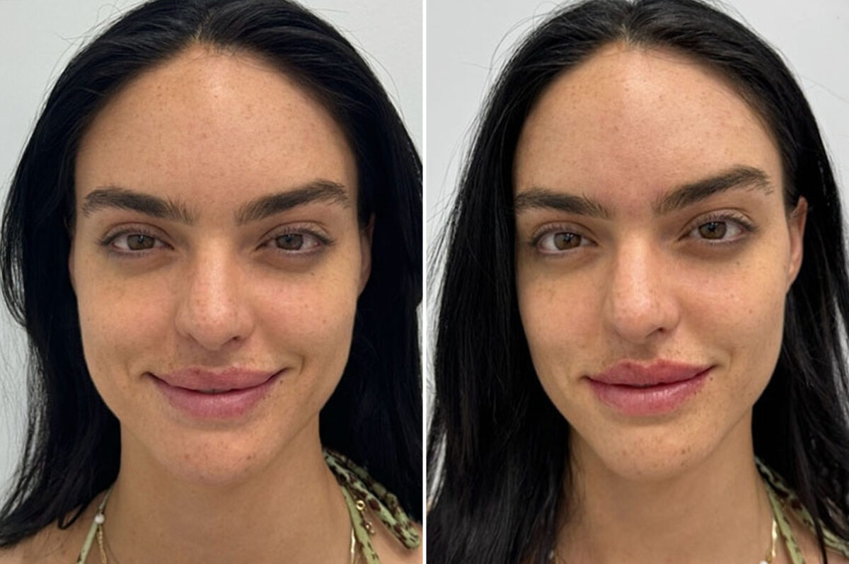 Lip Fillers Before and After Photos in Miami Beach, FL, Patient 2976